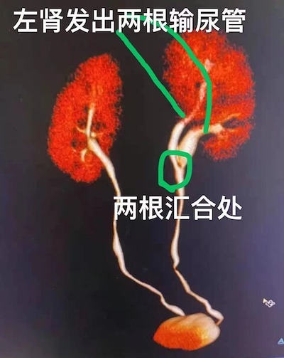检查结果显示,左侧肾结石结石体积较之前增大至约2厘米,同时合并左肾