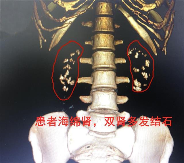 活动后血尿,以及高热等不适,要第一时间前往正规医院泌尿专科排除结石