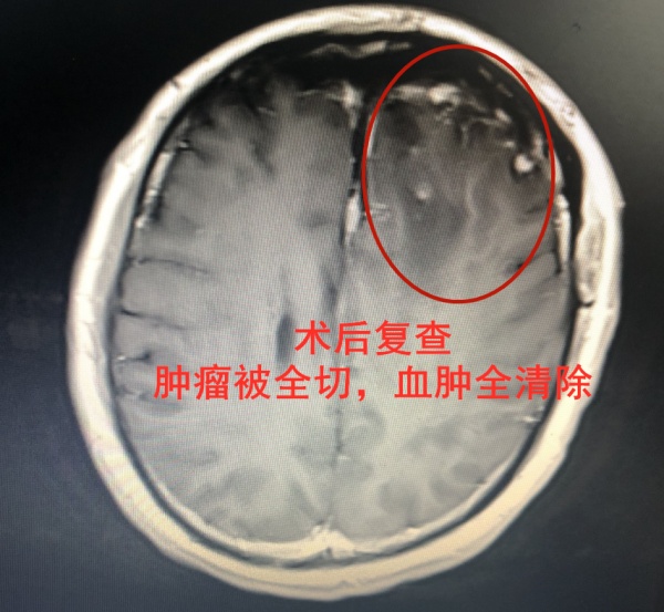 岑波表示,这是因为部分脑肿瘤出血后的发病症状与卒中发作相似,都是以