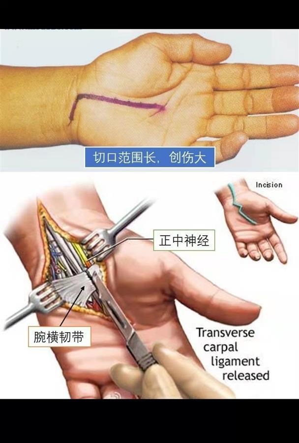 睡梦中经常被麻醒医生用微创手术赶走鼠标手