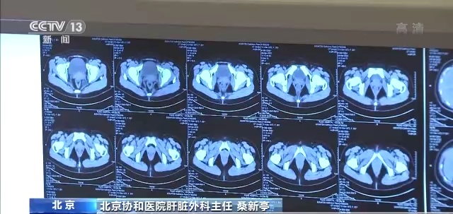 北京协和医院肝脏外科主任 桑新亭:很遗憾,我们看到很多来自农村地区