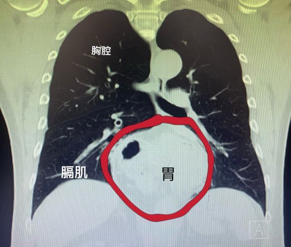 每次吃完饭,他总感觉胃顶得难受,一平躺反酸就更严重,有时候直接反流