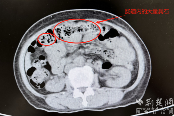 女子腹部肿胀如球  竟是肠道三分之一被“石头”堵死