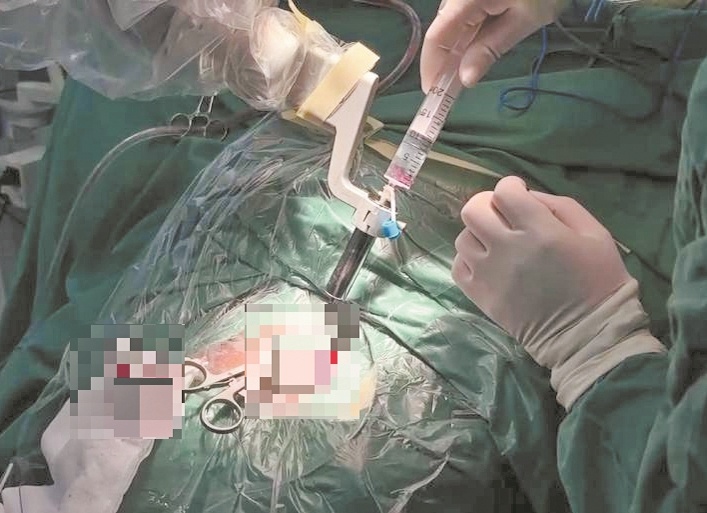 患者脑干出血14毫升 机器人协助医生救人