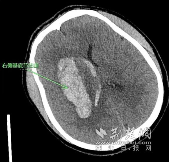 男子长期“开夜车” 突发脑出血引发车祸  医护团队紧急救治终化险为夷