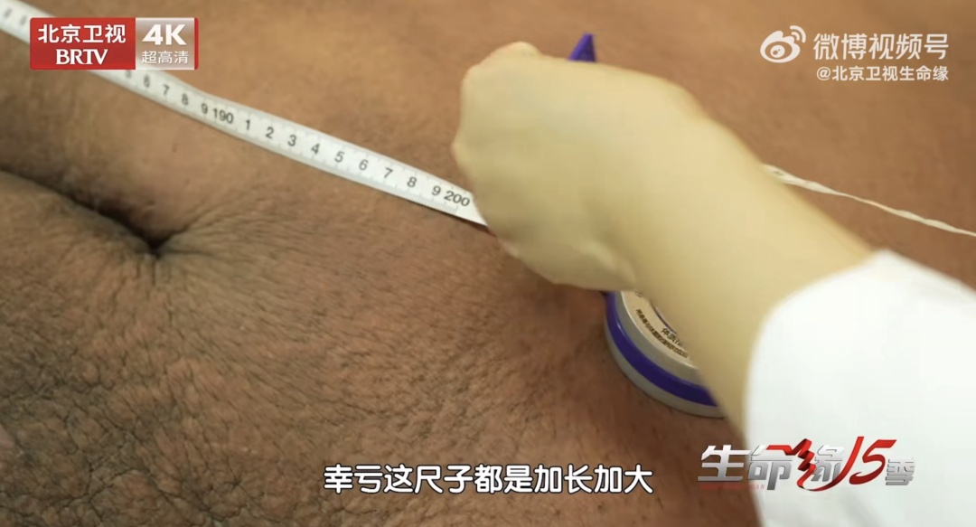 曾一顿吃25MK体育个包子、躺货车进京就医的他减重300多斤！(图4)