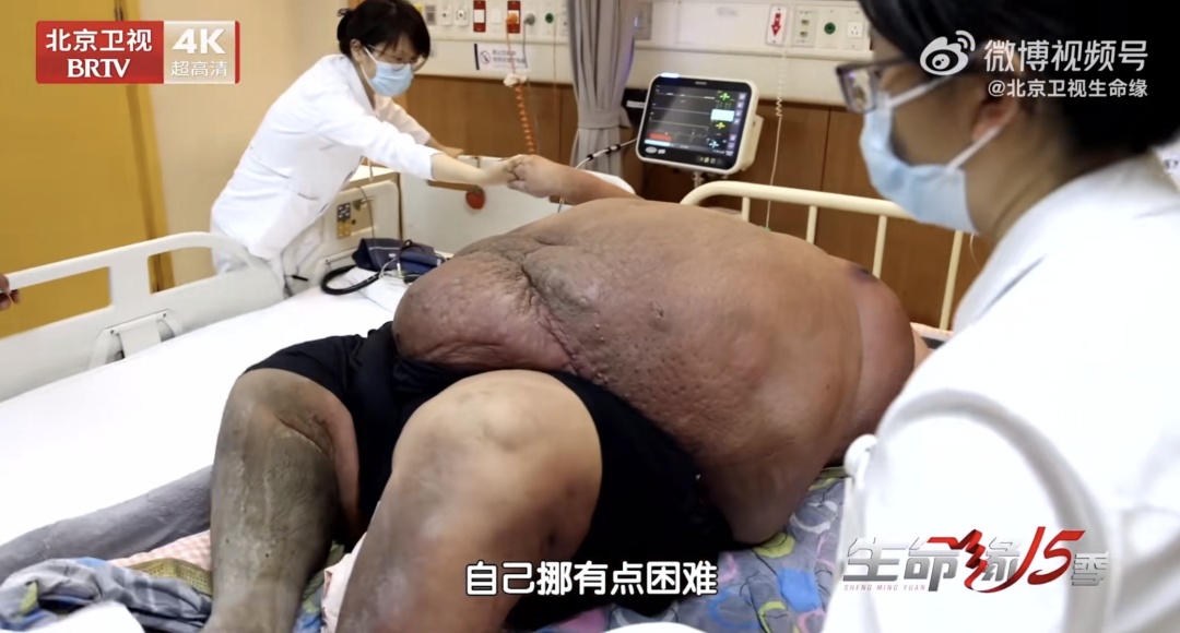 曾一顿吃25MK体育个包子、躺货车进京就医的他减重300多斤！(图5)