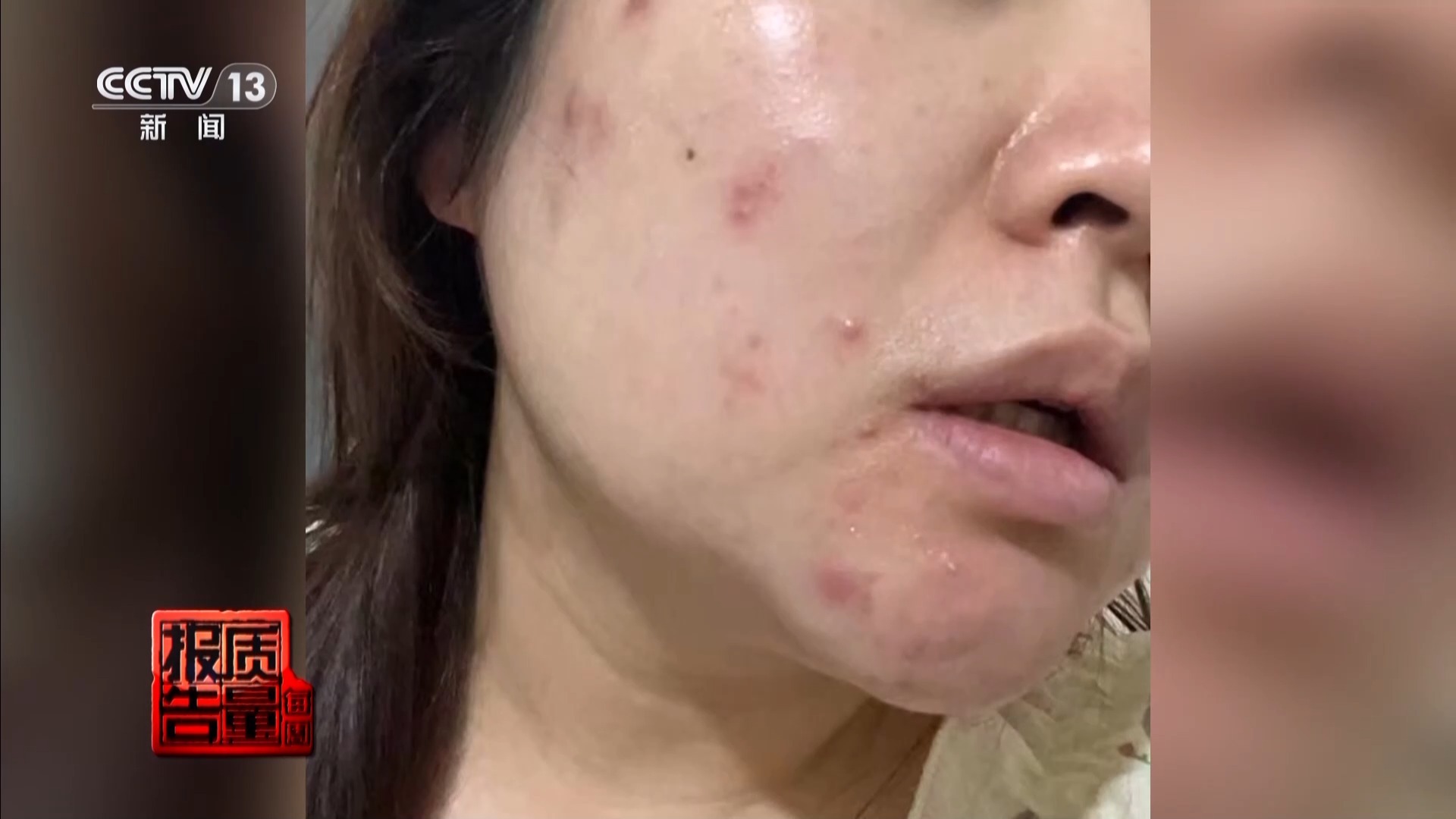 每周质量报告丨痤疮不会减少，但在“针清除”