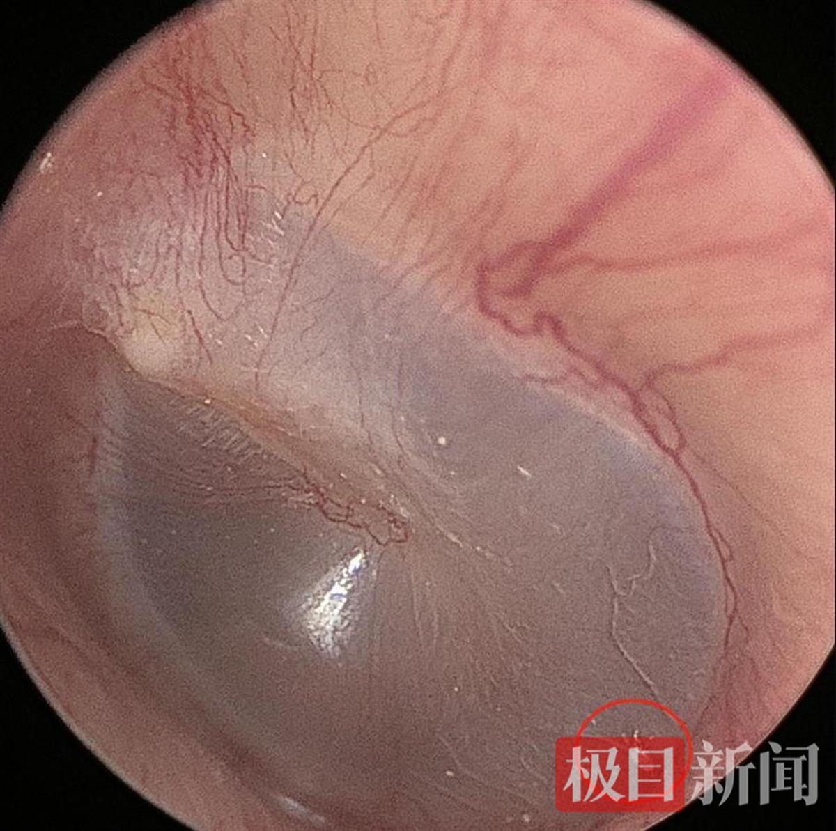 男子长期和宠物猫一起睡觉医生从他的耳道里取出了活体猫螨虫(图1)
