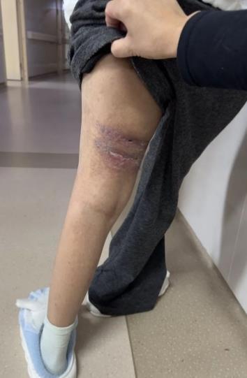 15岁女孩在成都一KTV陪酒坠楼致残，3人被判刑，母亲：补偿款一向没收到