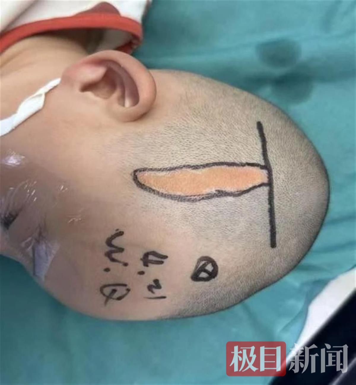 在一个3岁的孩子“扔炸弹”后,这些医生使用“