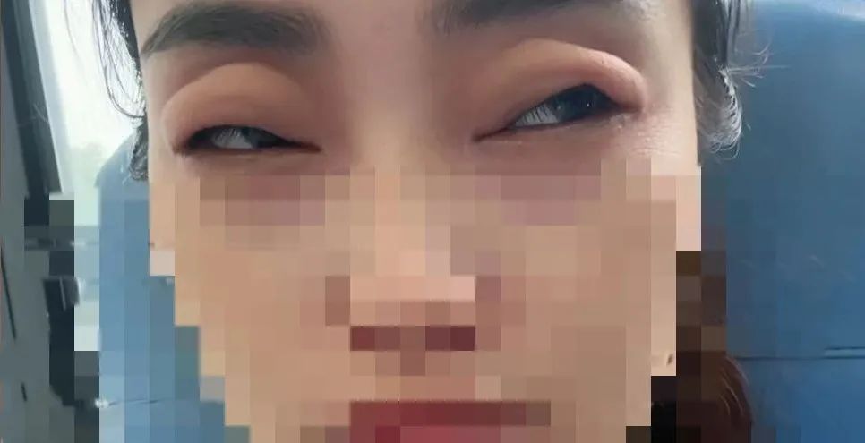 六月“顶流”生果，女子吃完秒变“哀痛蛙”！医师：“稀有却阴险”