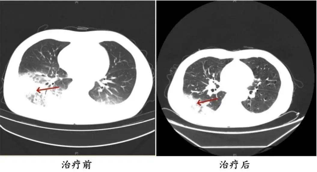 连吹3天空调致“白肺” 只因运用前忽视了这一点！