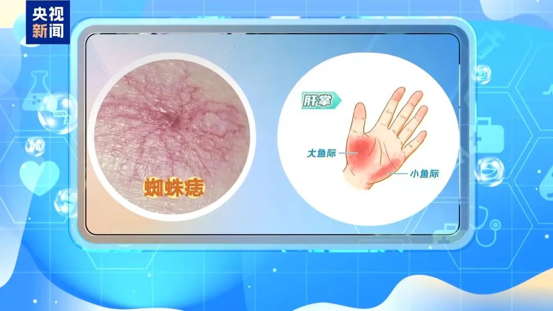 这个“信号”出现在皮肤上，但这可能是肝脏问