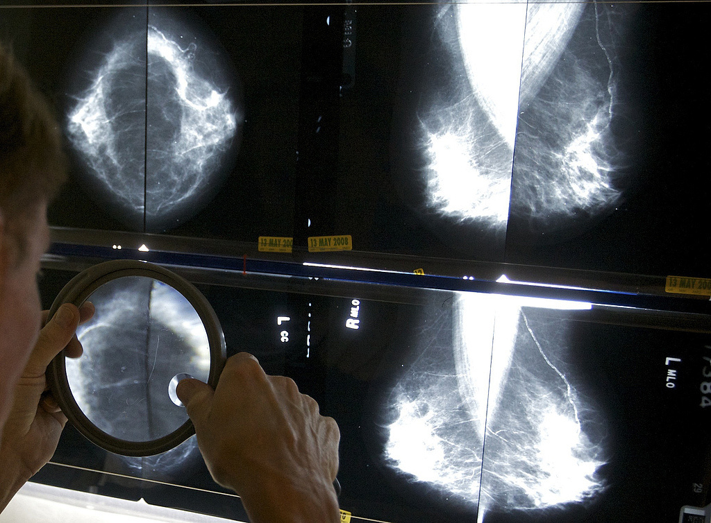 德研讨：定时承受乳腺X线筛查可明显下降乳腺癌死亡率