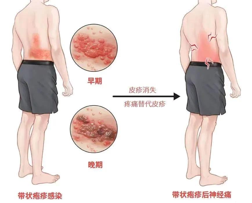 “最痛的皮肤病”已进入高峰期。如果出现这些