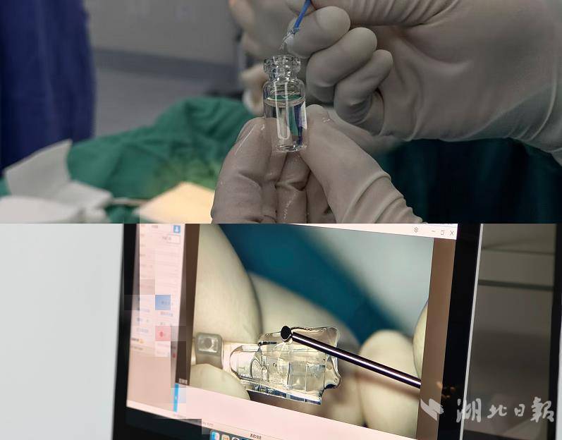 “摘掉眼镜”23年后，近视手术并非一次性解决