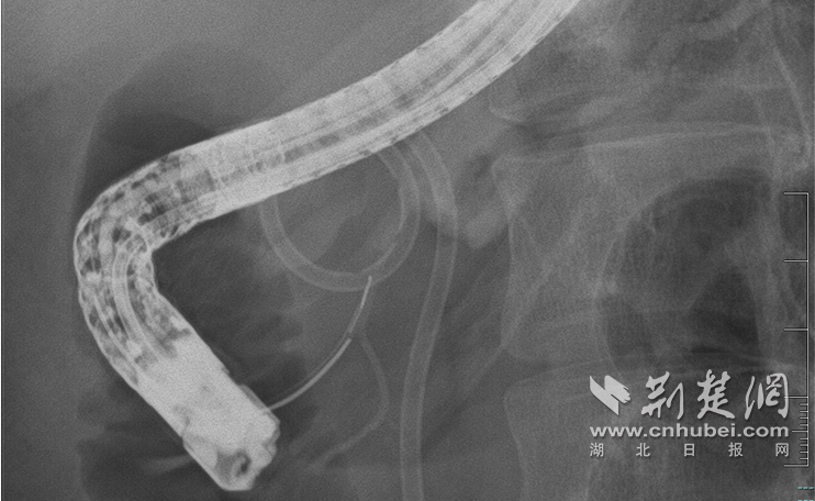 同济医生“穿针线”修复