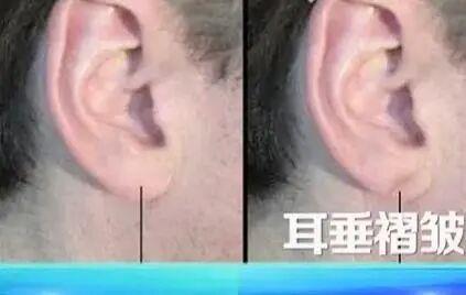 你的血管会被堵塞吗？看脸和腿就能看出来吗？ 6 个你不应该忽视的迹象