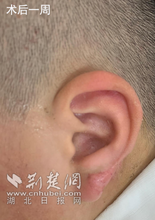 男童遭宠物狗咬伤耳廓缺损  医生精修成功还原