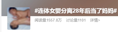 连体女婴分离28年后，当妈妈了！回到当年接受手术的医院生产，女儿小名叫……