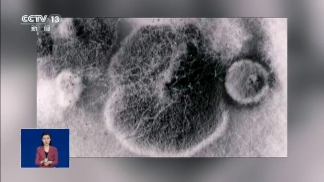  视频丨女孩脑部被真菌侵蚀出现“空洞”？大扫除要警惕霉变粉尘！