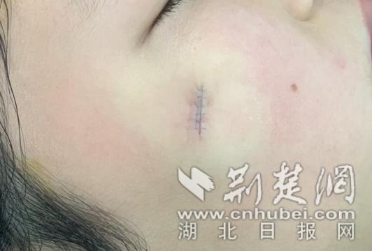  7岁女童美容院点痣不成反“养”大  医生巧施“显微美容缝合”除痣修复容颜