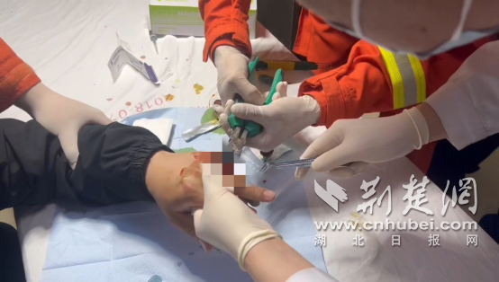 湖北荆门：男子手部受伤戒指卡住手指 消防两分钟成功取下