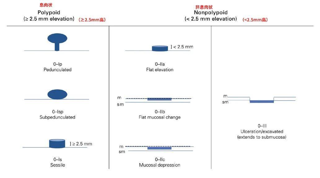  体检发现“息肉”别慌 一文读懂哪些会癌变、哪些不用切