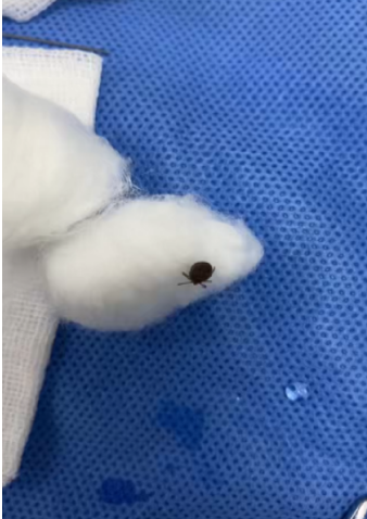 一周接诊多位蜱虫咬伤患者 医生紧急提醒：虫蛇咬伤高发季来了