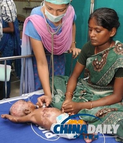 拉胡尔自出生起已自燃了4次。