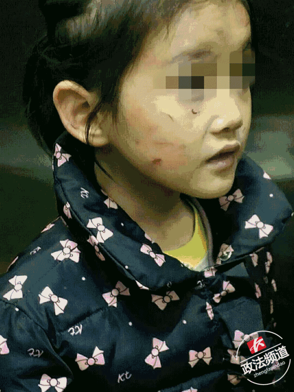 6岁女孩遭虐打 警方:生母涉嫌虐待罪被刑事拘留