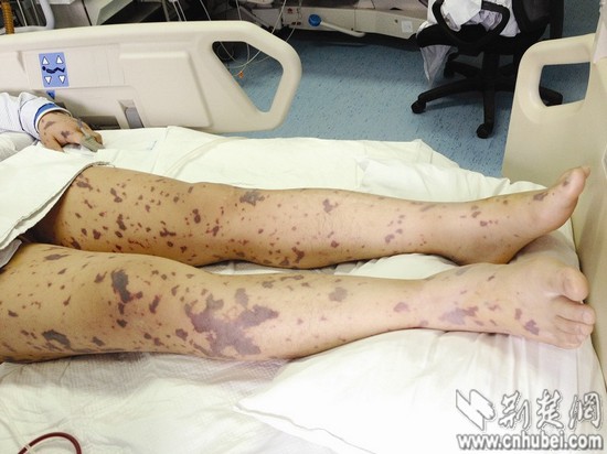 监利男子高烧后全身长豹纹多个器官衰竭险丧