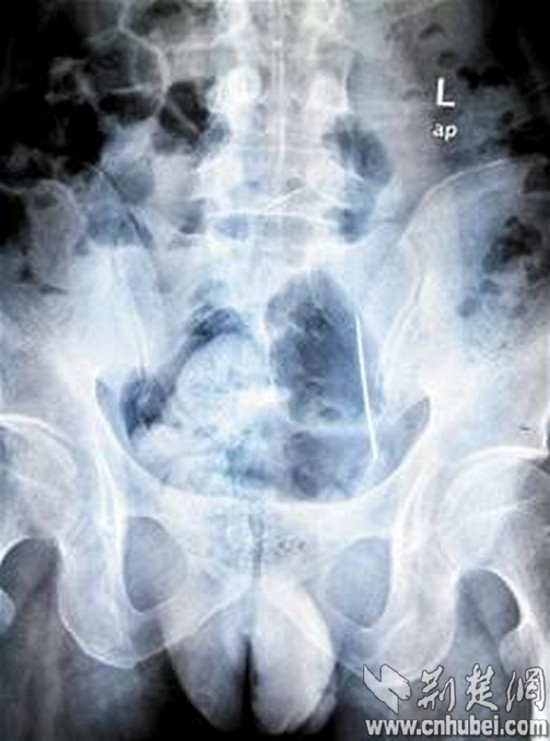 图为:ct与x光片显示吴先生腹部有两根缝衣针