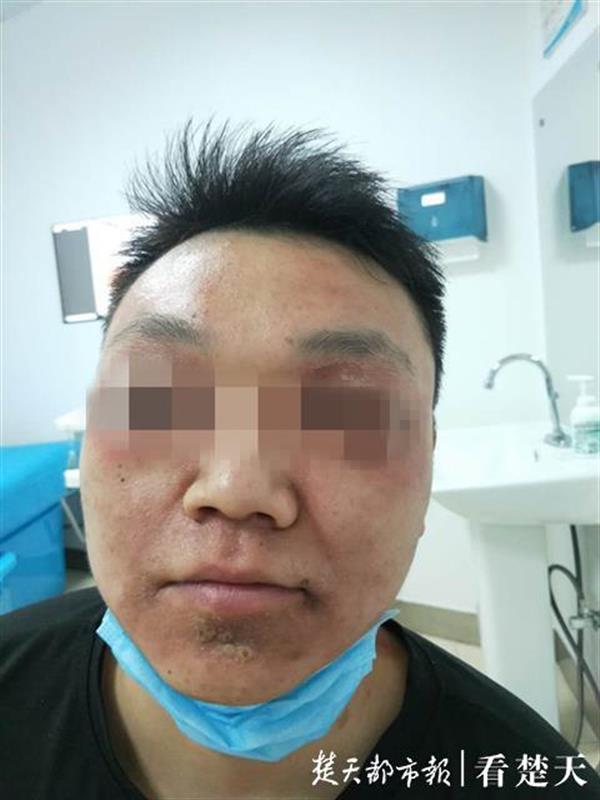 男子随手捏死一只"蚂蚁"险毁容,专家提醒夏季在户外要当心隐翅虫