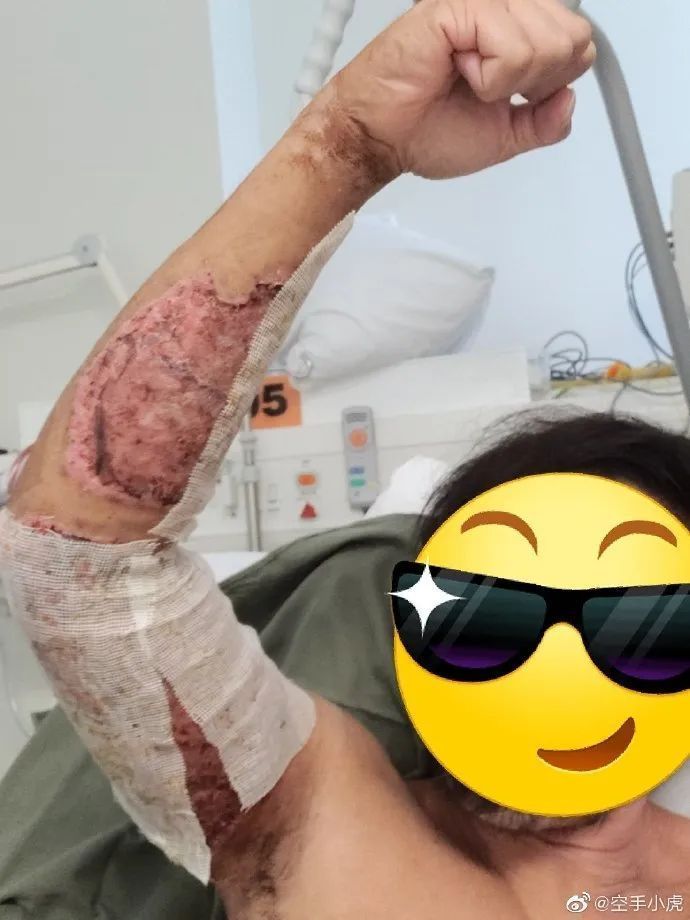 港警小虎sir解下纱布这一幕太心疼