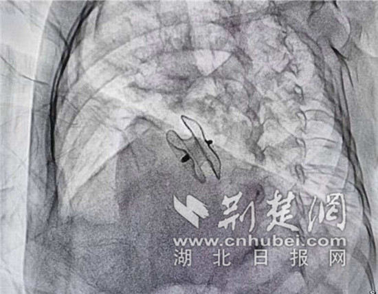 通过介入手术在心内撑开一把小伞修补缺口通讯员供图