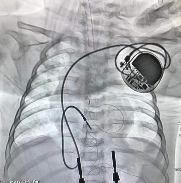 体内起搏器图片