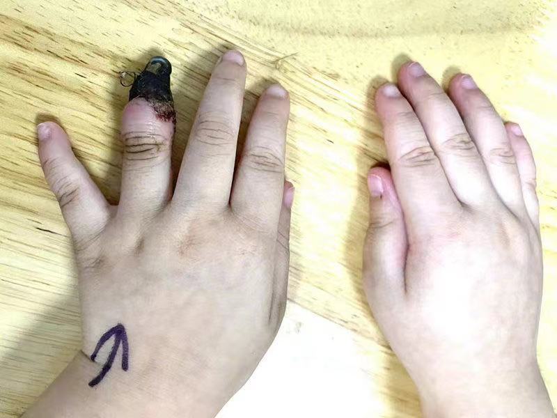 错误包扎致3岁女童手指坏死 你真的懂如何包扎伤口吗?