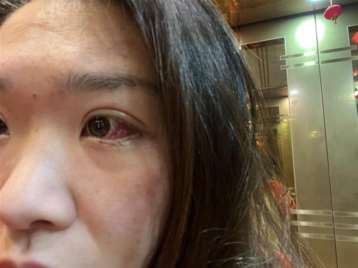 因为被检查出眼底脉络膜恶性黑色素瘤,医生建议她做重离子质子放疗,而