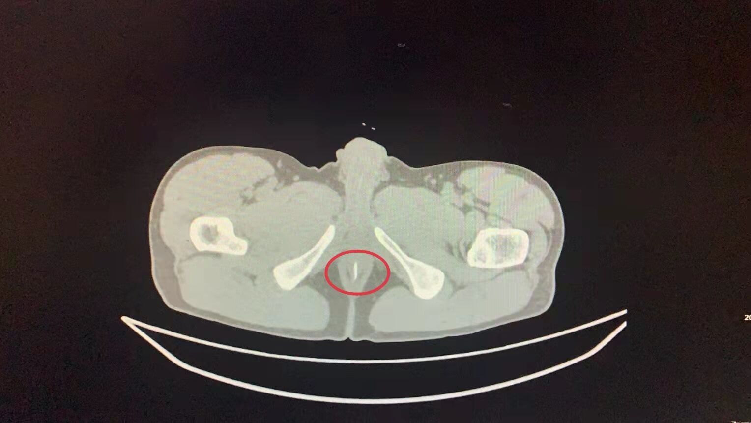 男子喝银耳红枣汤囫囵吞枣半颗枣核卡肛门引发感染
