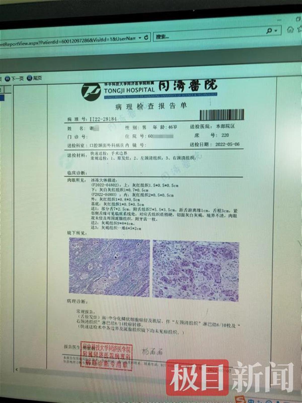 病理报告单 肿瘤图片