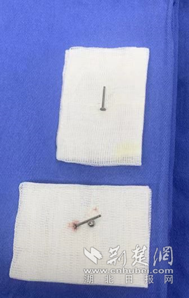 爱美女子脸上打入两颗酒窝钉两周后嵌入脸颊险毁容