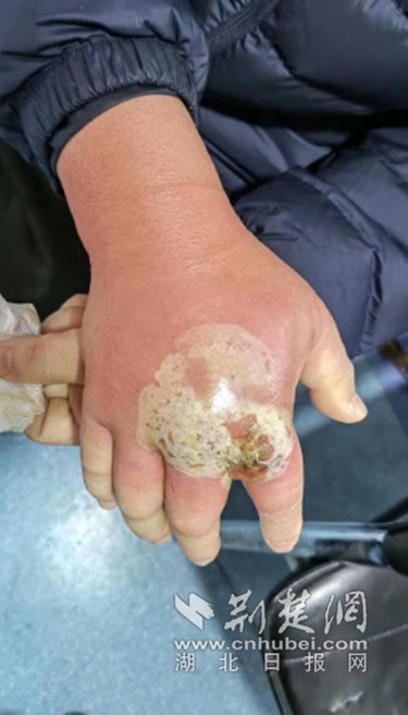 火烧细针自挑脓泡 男子奇葩操作险"失手"-荆楚网-湖北日报网