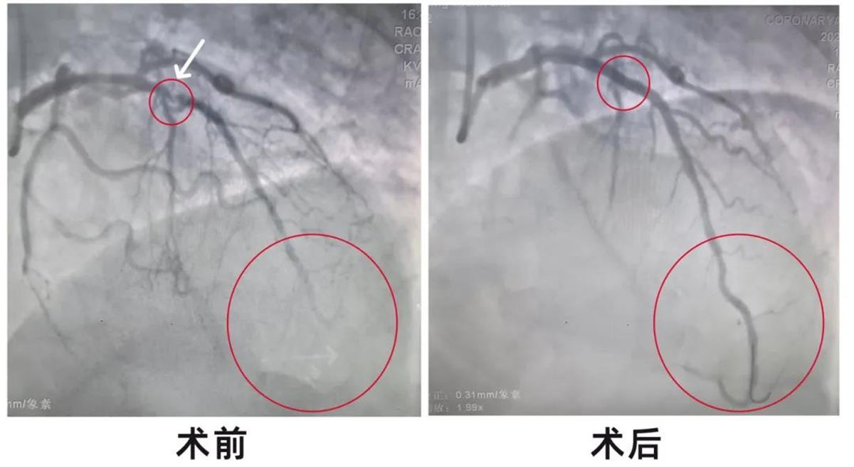 老人囤救心丸保命 医生提醒 不是治疗用药