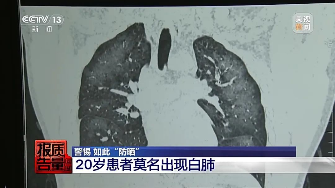 前不久,湖南长沙一医院,一患者因呼吸困难和咳嗽前来就诊,ct影像显示