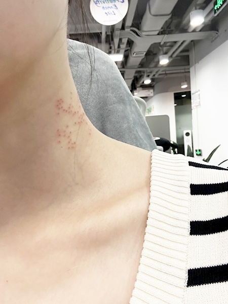 美容店"点疣",办卡花了两万多元  女子感觉自己受