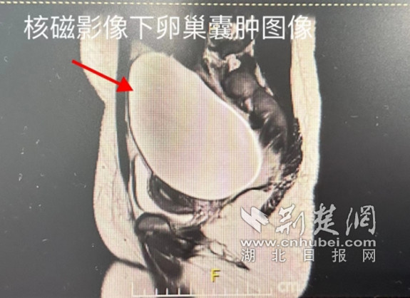 妇科囊肿图片 b超图片