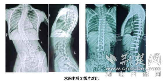 出脊柱侧弯,没想到仅过了一个月再次检查时发现其侧弯度就增加了10度