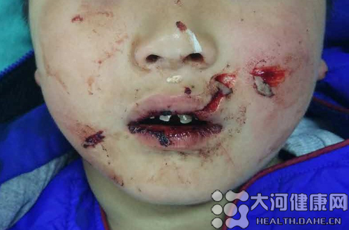 7岁孩子被妈妈强行灌感冒药面部割伤险毁容